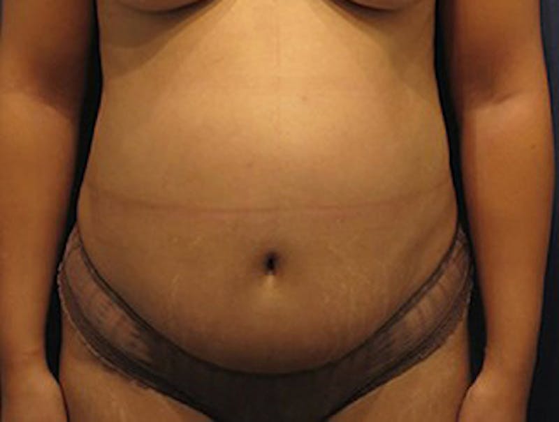 Liposuction Before & After Gallery - Patient 174163221 - Image 5