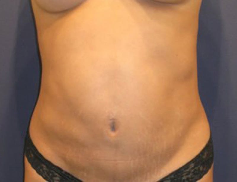 Liposuction Before & After Gallery - Patient 174163221 - Image 6