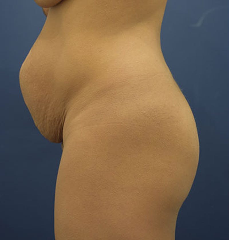 Liposuction Before & After Gallery - Patient 174163230 - Image 1