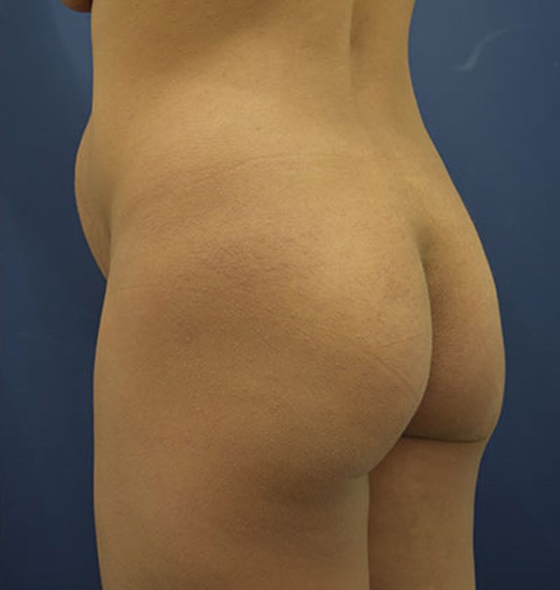 Liposuction Before & After Gallery - Patient 174163230 - Image 2