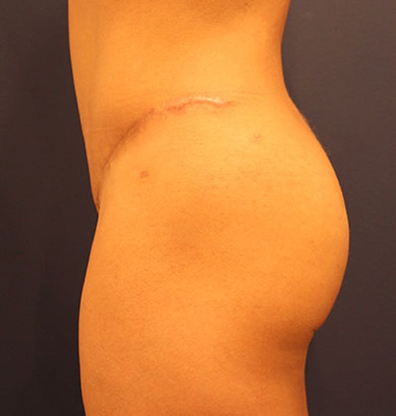 Liposuction Before & After Gallery - Patient 174163230 - Image 4
