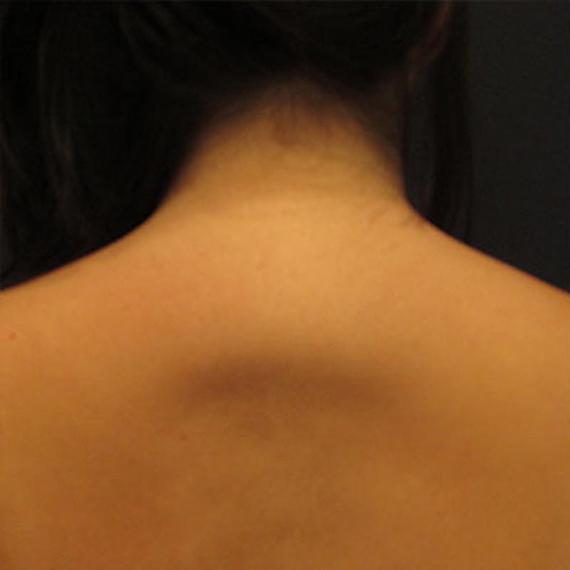 Liposuction Before & After Gallery - Patient 174163234 - Image 1