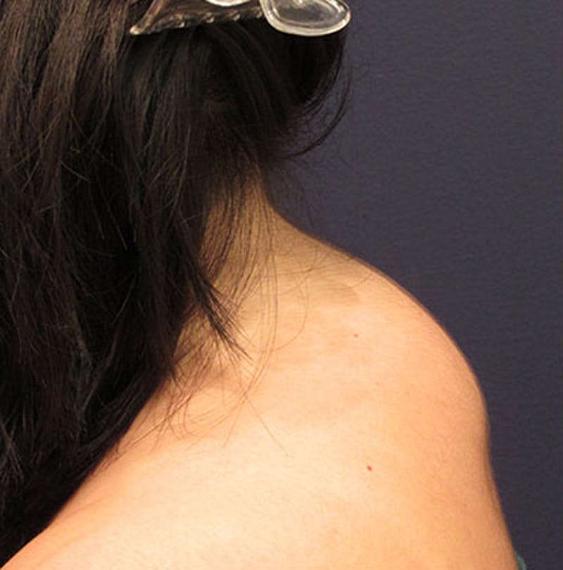 Liposuction Before & After Gallery - Patient 174163234 - Image 2