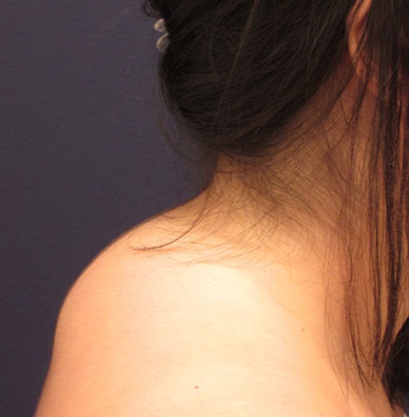 Liposuction Before & After Gallery - Patient 174163234 - Image 3