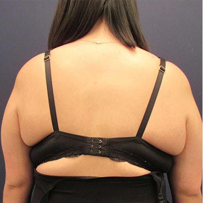 Liposuction Before & After Gallery - Patient 174163234 - Image 4