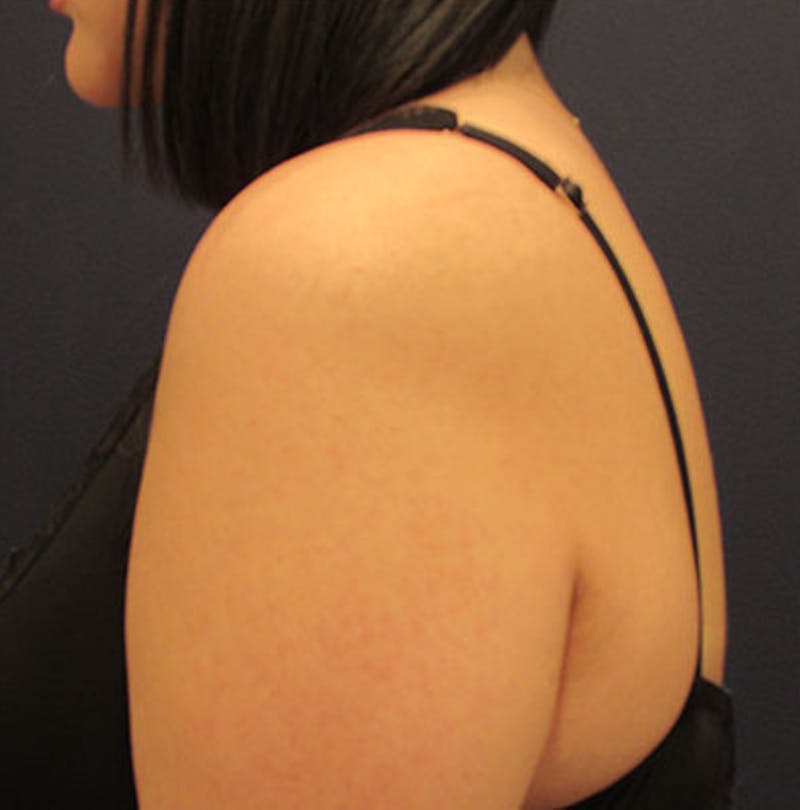 Liposuction Before & After Gallery - Patient 174163234 - Image 5