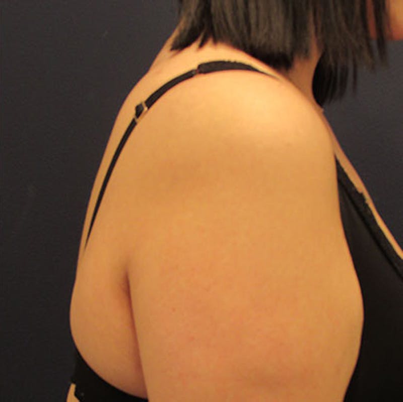 Liposuction Before & After Gallery - Patient 174163234 - Image 6