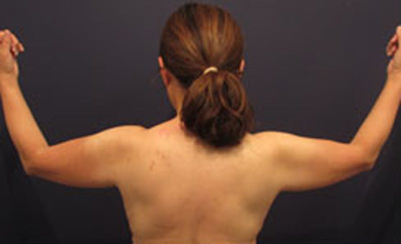 Liposuction Before & After Gallery - Patient 174163241 - Image 1