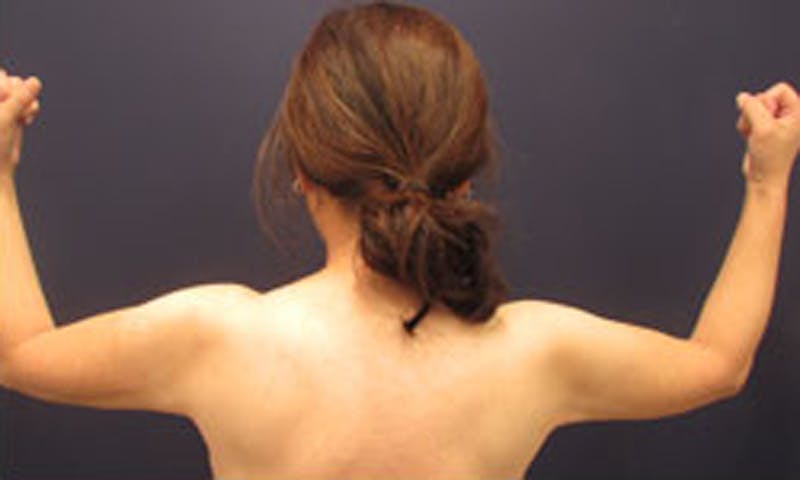 Liposuction Before & After Gallery - Patient 174163241 - Image 2