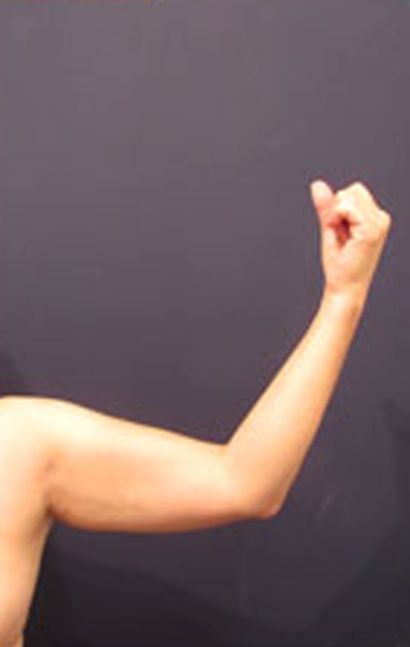 Liposuction Before & After Gallery - Patient 174163241 - Image 3