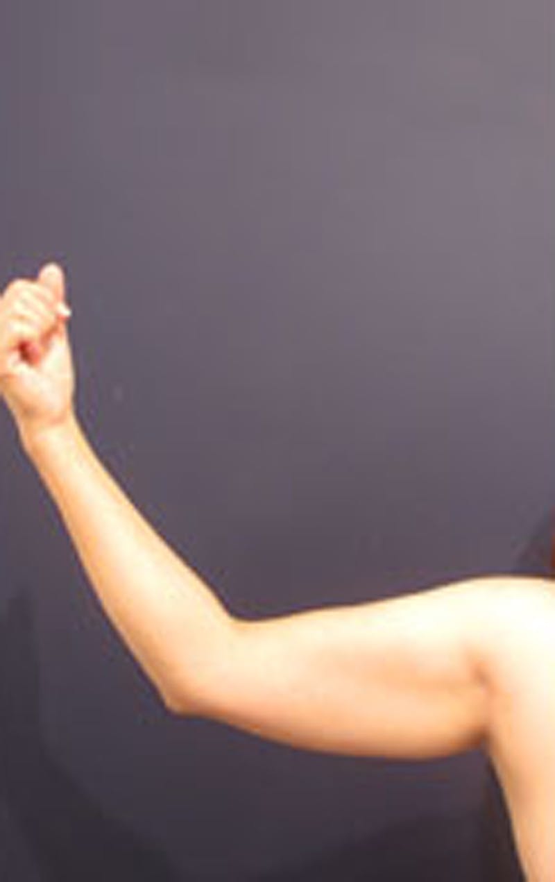 Liposuction Before & After Gallery - Patient 174163241 - Image 5