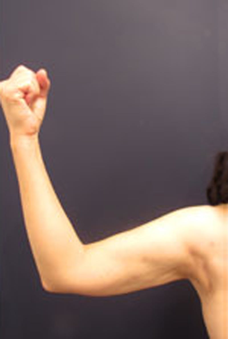 Liposuction Before & After Gallery - Patient 174163241 - Image 6