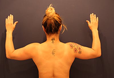 Liposuction Before & After Gallery - Patient 174163248 - Image 1