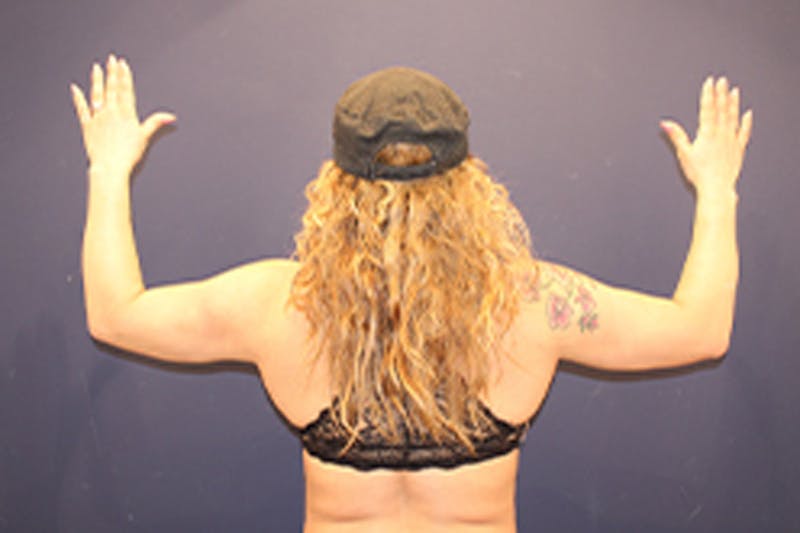 Liposuction Before & After Gallery - Patient 174163248 - Image 2