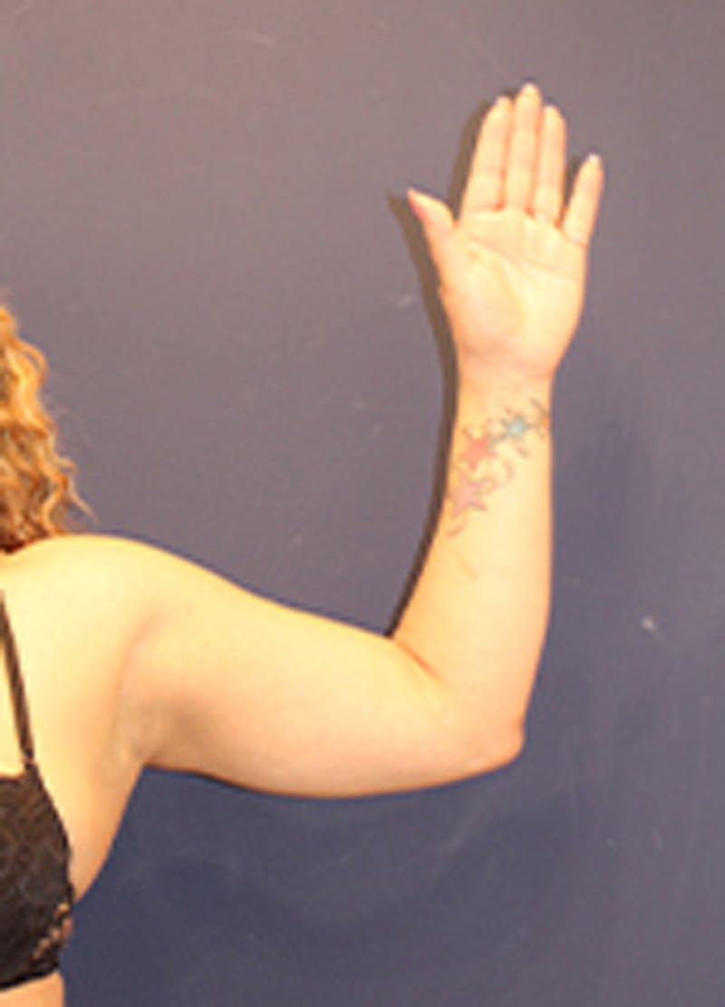 Liposuction Before & After Gallery - Patient 174163248 - Image 4