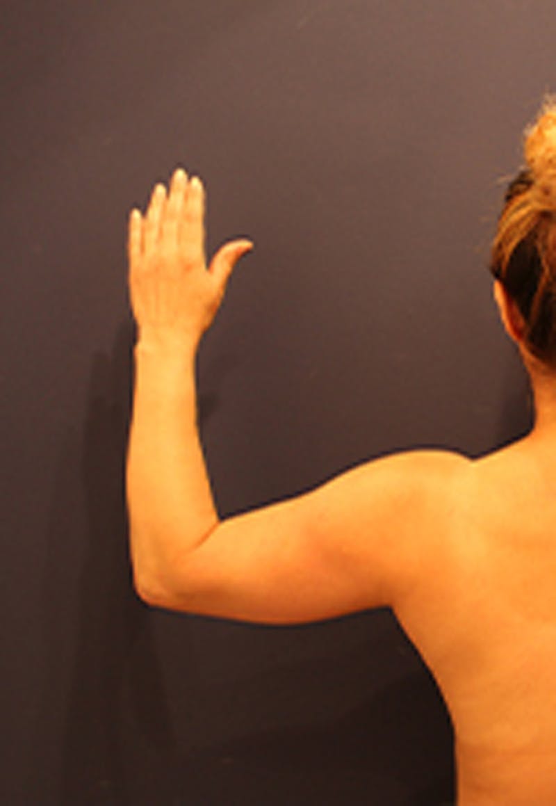 Liposuction Before & After Gallery - Patient 174163248 - Image 5