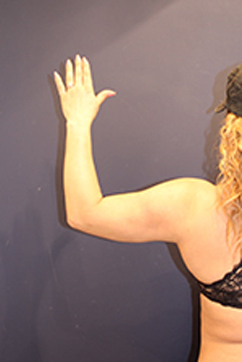 Liposuction Before & After Gallery - Patient 174163248 - Image 6