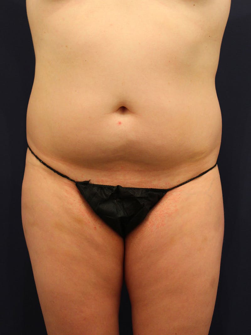 Liposuction Before & After Gallery - Patient 174163263 - Image 1