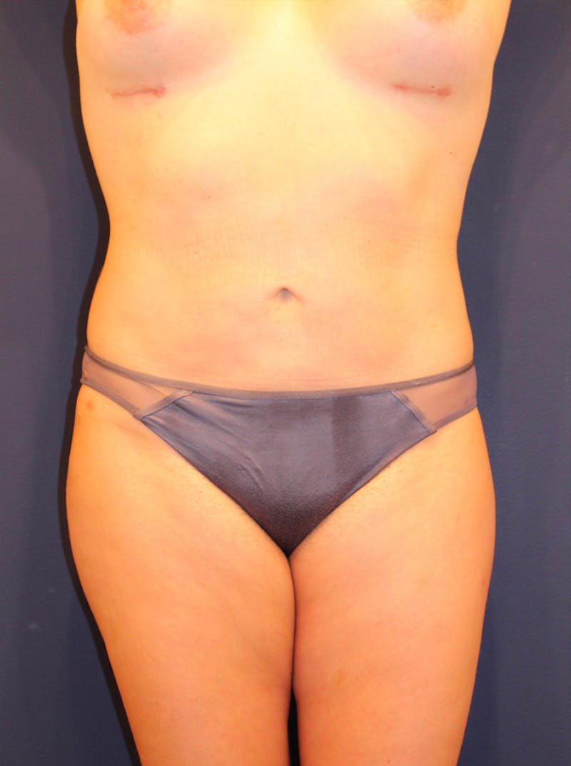 Liposuction Before & After Gallery - Patient 174163263 - Image 2