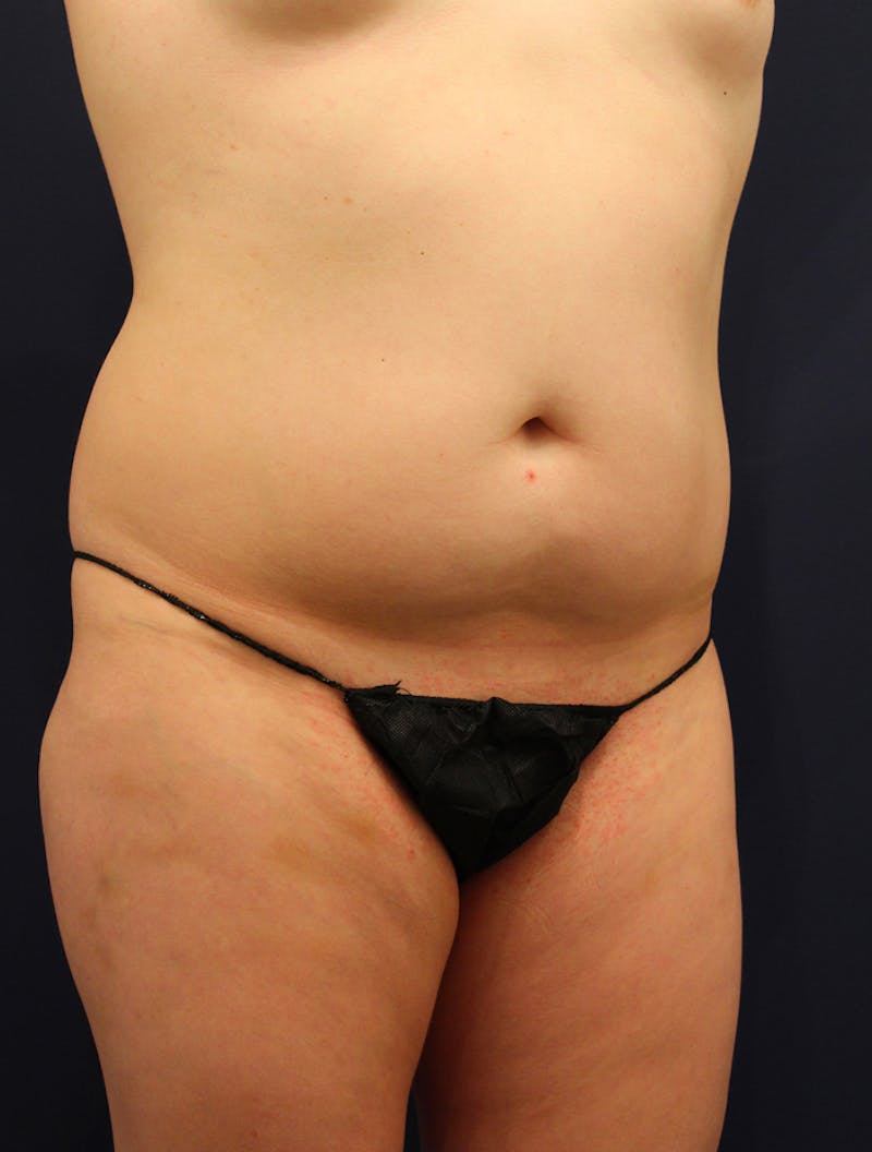 Liposuction Before & After Gallery - Patient 174163263 - Image 3