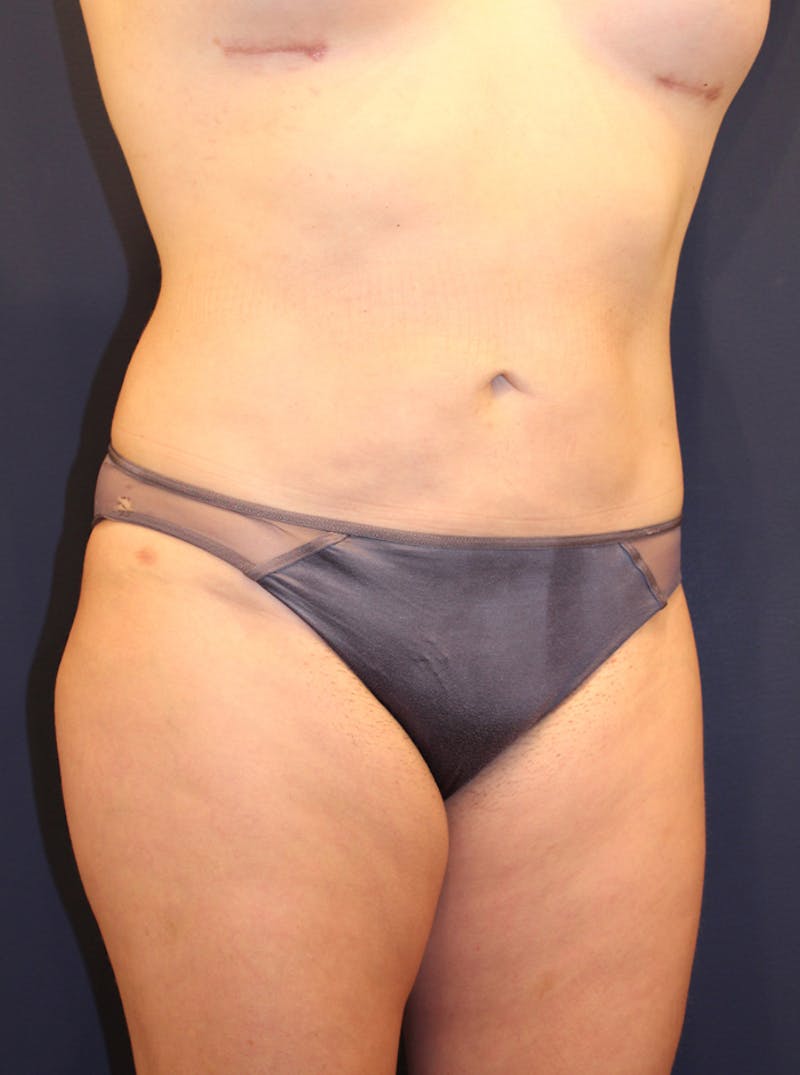 Liposuction Before & After Gallery - Patient 174163263 - Image 4