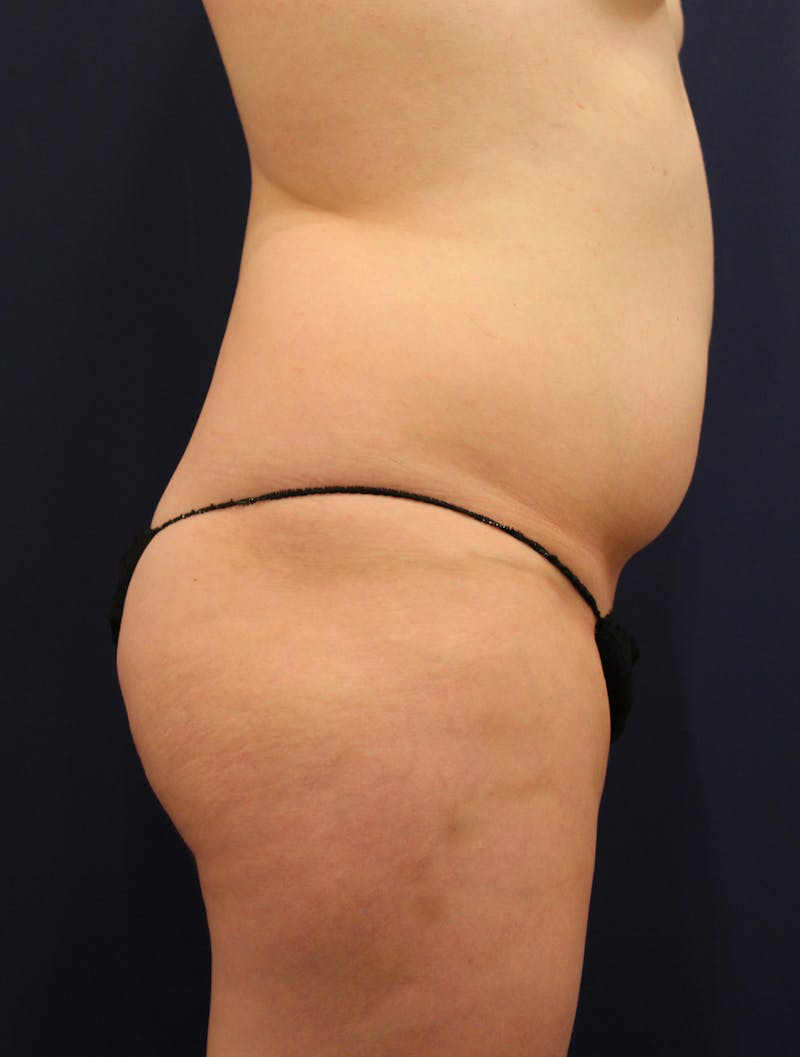 Liposuction Before & After Gallery - Patient 174163263 - Image 5
