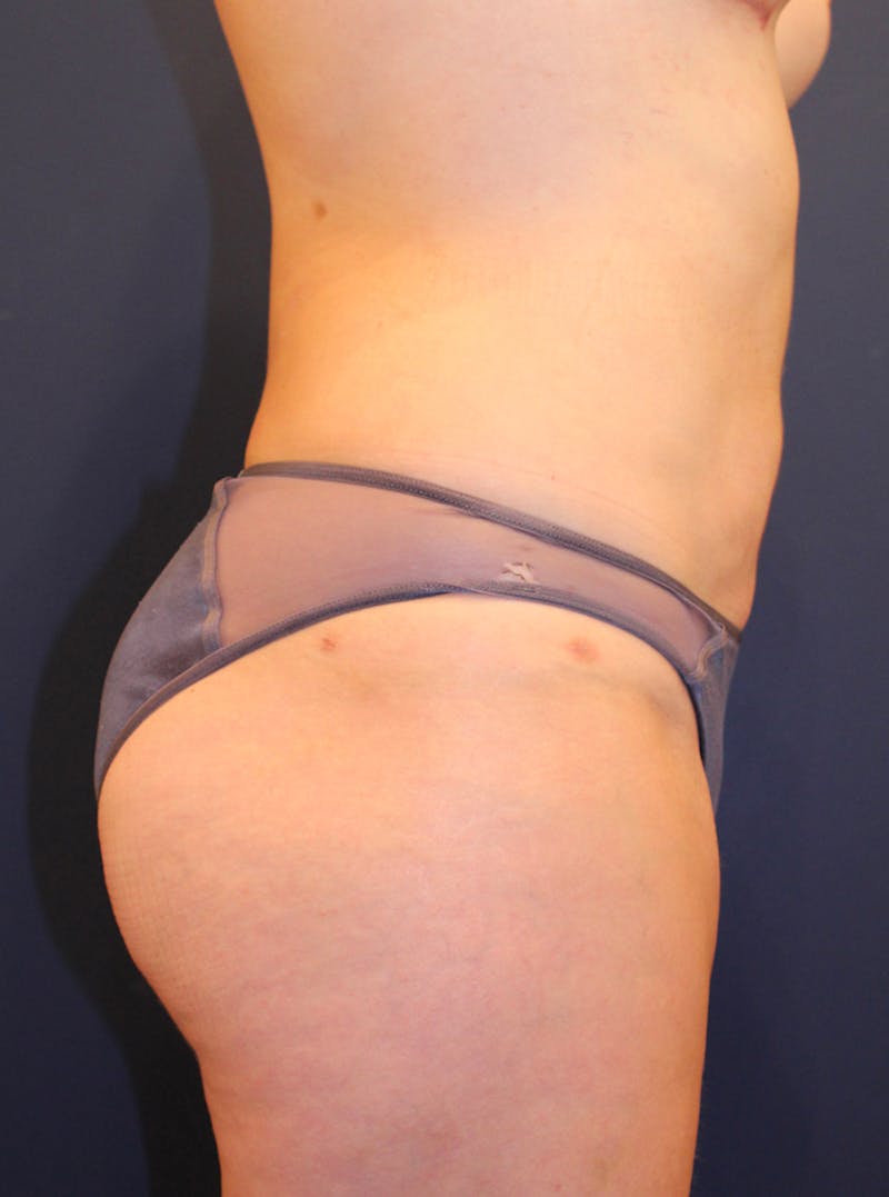 Liposuction Before & After Gallery - Patient 174163263 - Image 6