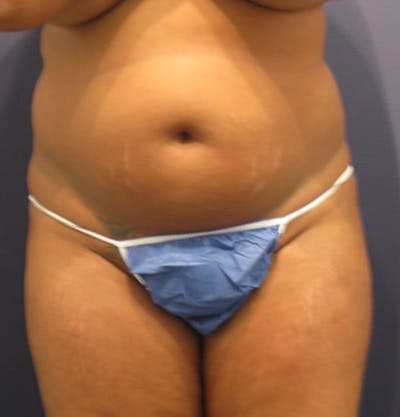 Liposuction Before & After Gallery - Patient 174163270 - Image 1