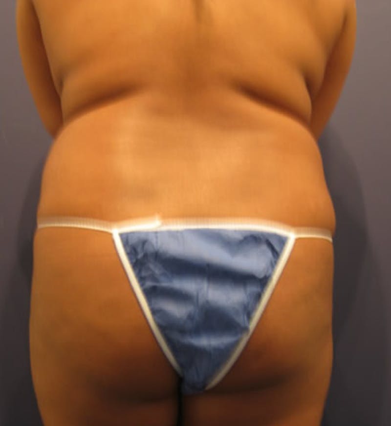 Liposuction Before & After Gallery - Patient 174163270 - Image 3