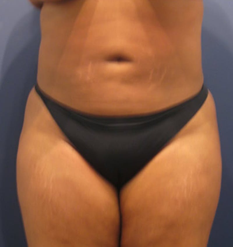 Liposuction Before & After Gallery - Patient 174163270 - Image 4