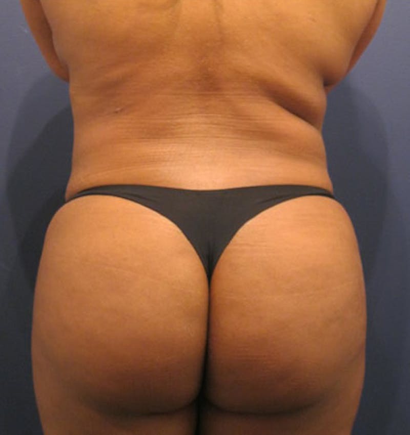Liposuction Before & After Gallery - Patient 174163270 - Image 6