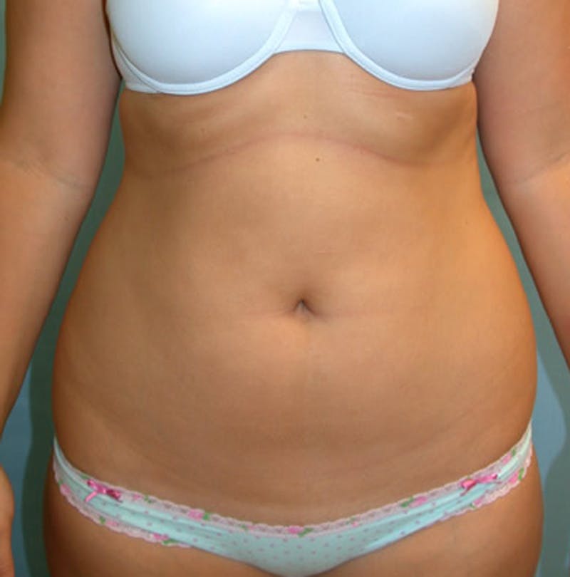 Liposuction Before & After Gallery - Patient 174163277 - Image 1