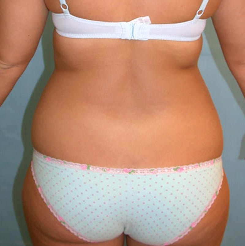 Liposuction Before & After Gallery - Patient 174163277 - Image 2
