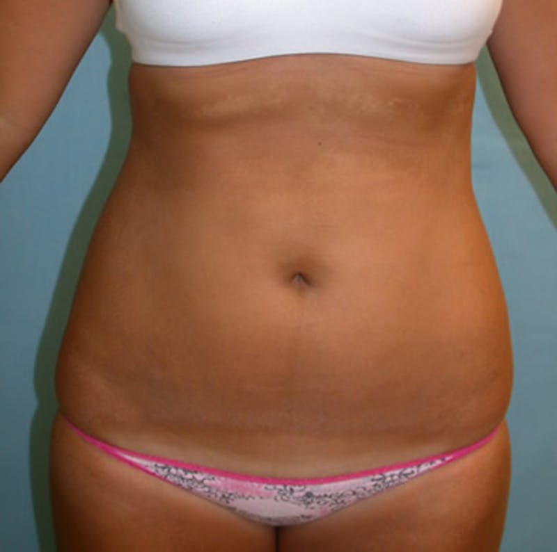 Liposuction Before & After Gallery - Patient 174163277 - Image 4