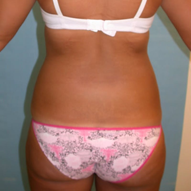 Liposuction Before & After Gallery - Patient 174163277 - Image 5