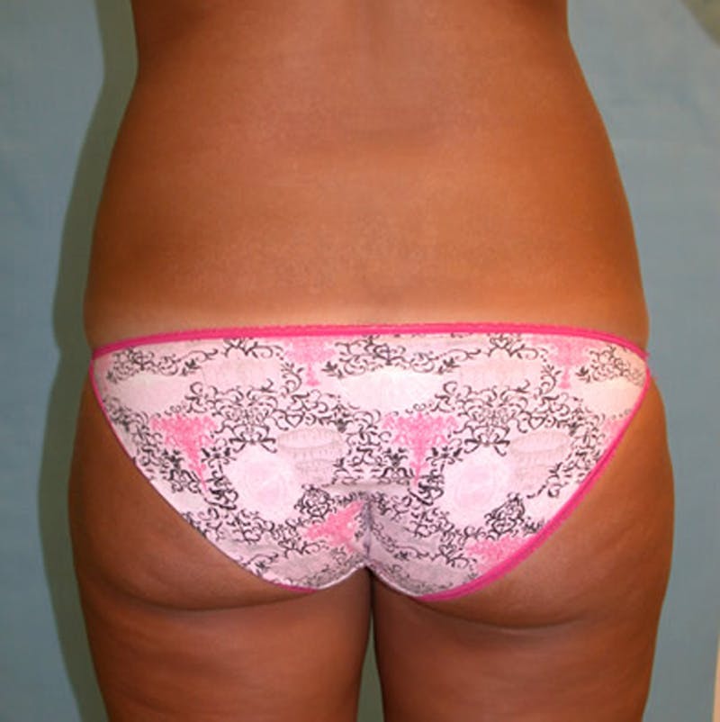 Liposuction Before & After Gallery - Patient 174163277 - Image 6