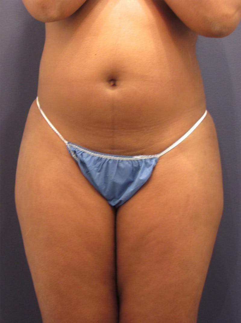Liposuction Before & After Gallery - Patient 174163294 - Image 1