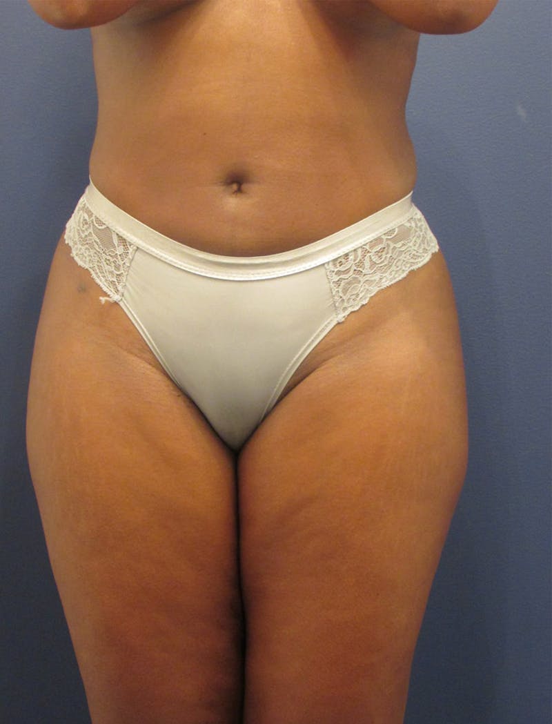 Liposuction Before & After Gallery - Patient 174163294 - Image 2