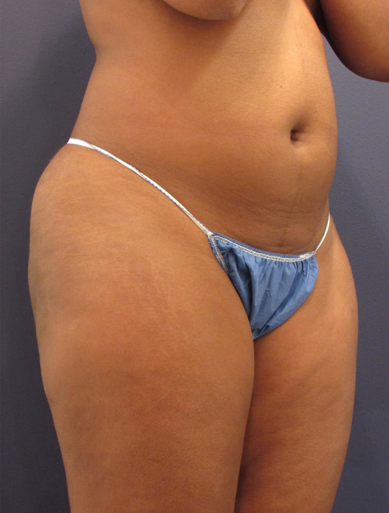 Liposuction Before & After Gallery - Patient 174163294 - Image 3