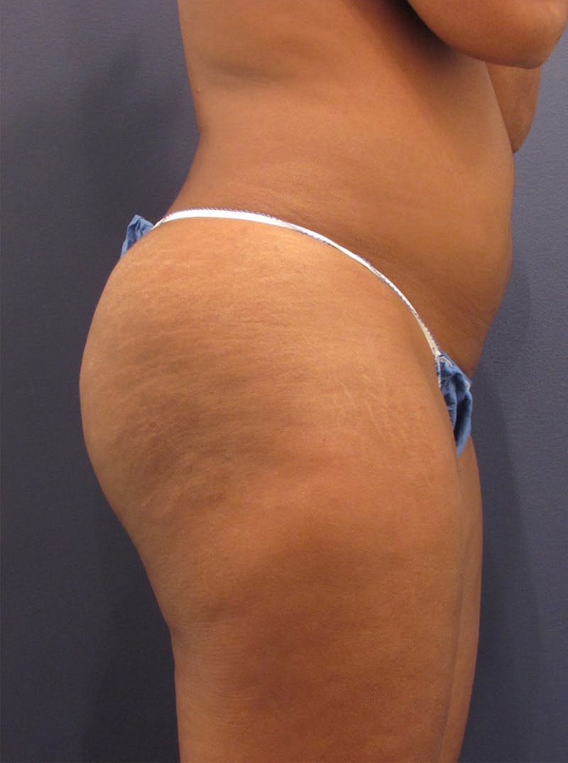 Liposuction Before & After Gallery - Patient 174163294 - Image 5