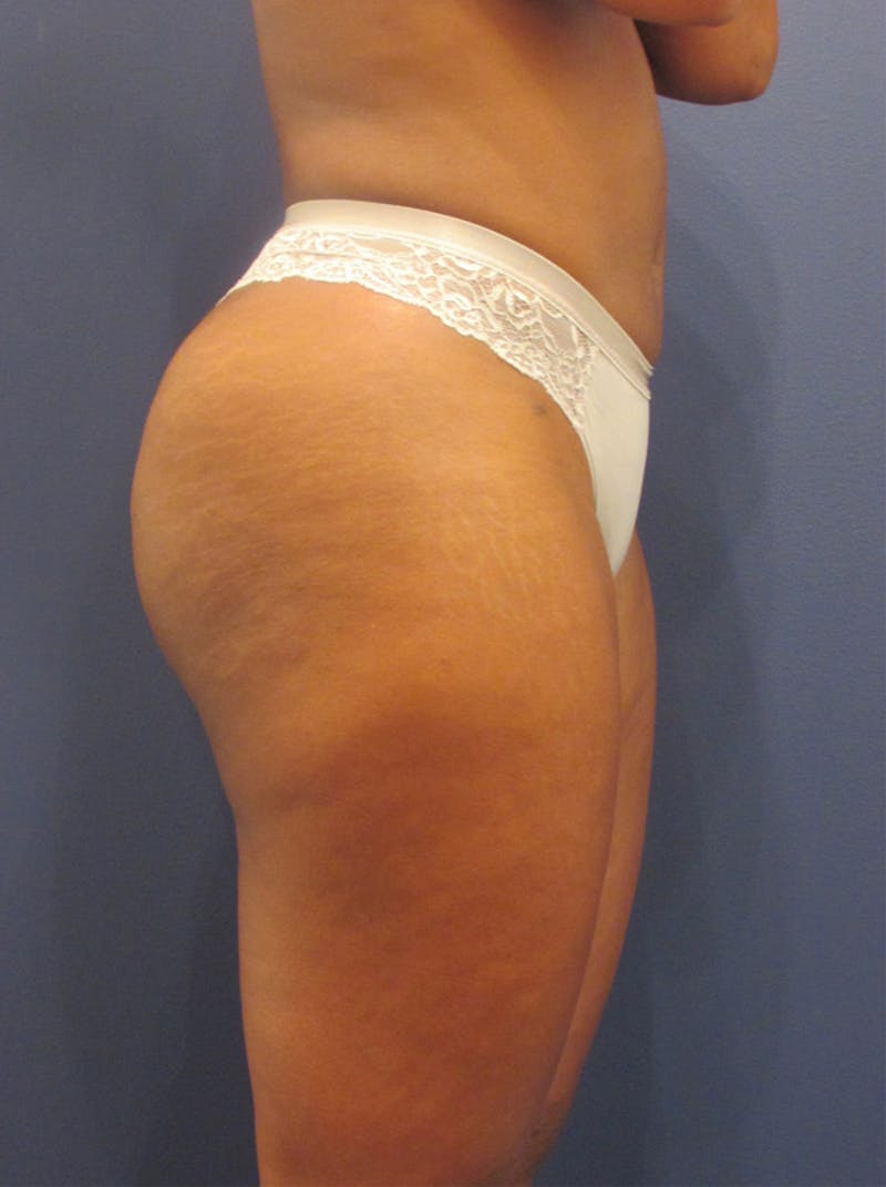 Liposuction Before & After Gallery - Patient 174163294 - Image 6