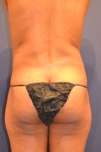 Liposuction Before & After Gallery - Patient 174163300 - Image 1