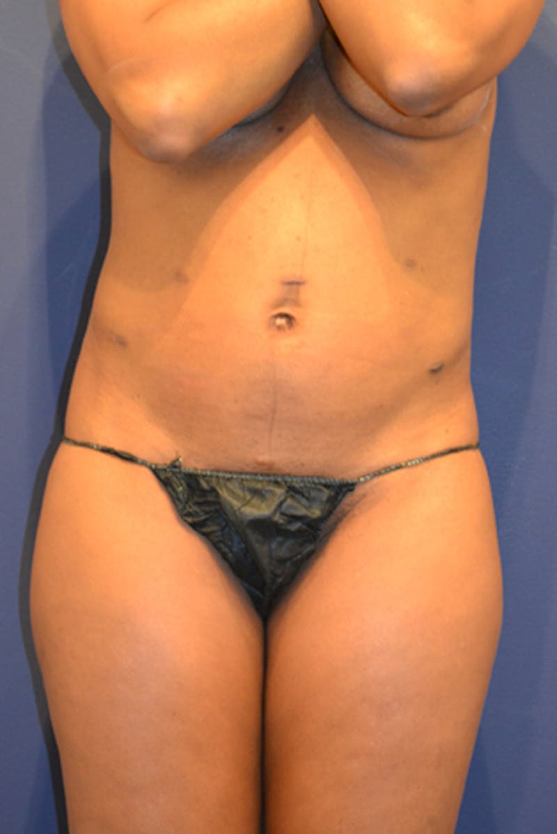 Liposuction Before & After Gallery - Patient 174163300 - Image 3