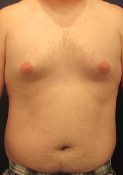 Liposuction Before & After Gallery - Patient 174163306 - Image 1