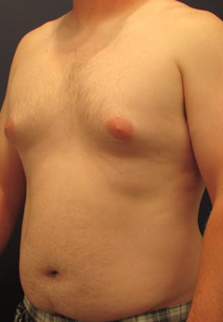Liposuction Before & After Gallery - Patient 174163306 - Image 2
