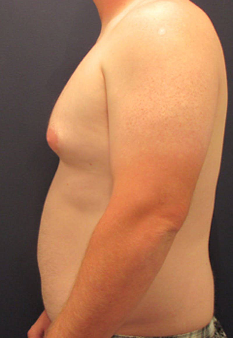 Liposuction Before & After Gallery - Patient 174163306 - Image 3