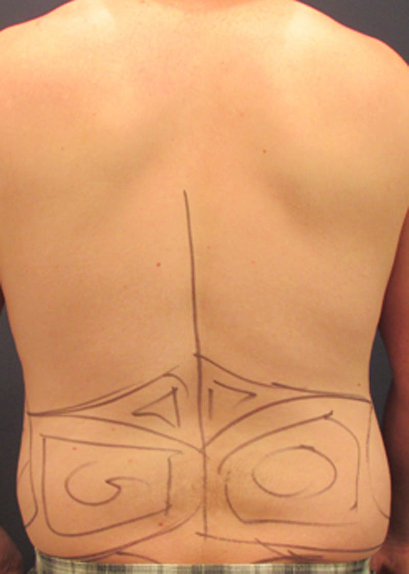 Liposuction Before & After Gallery - Patient 174163306 - Image 4