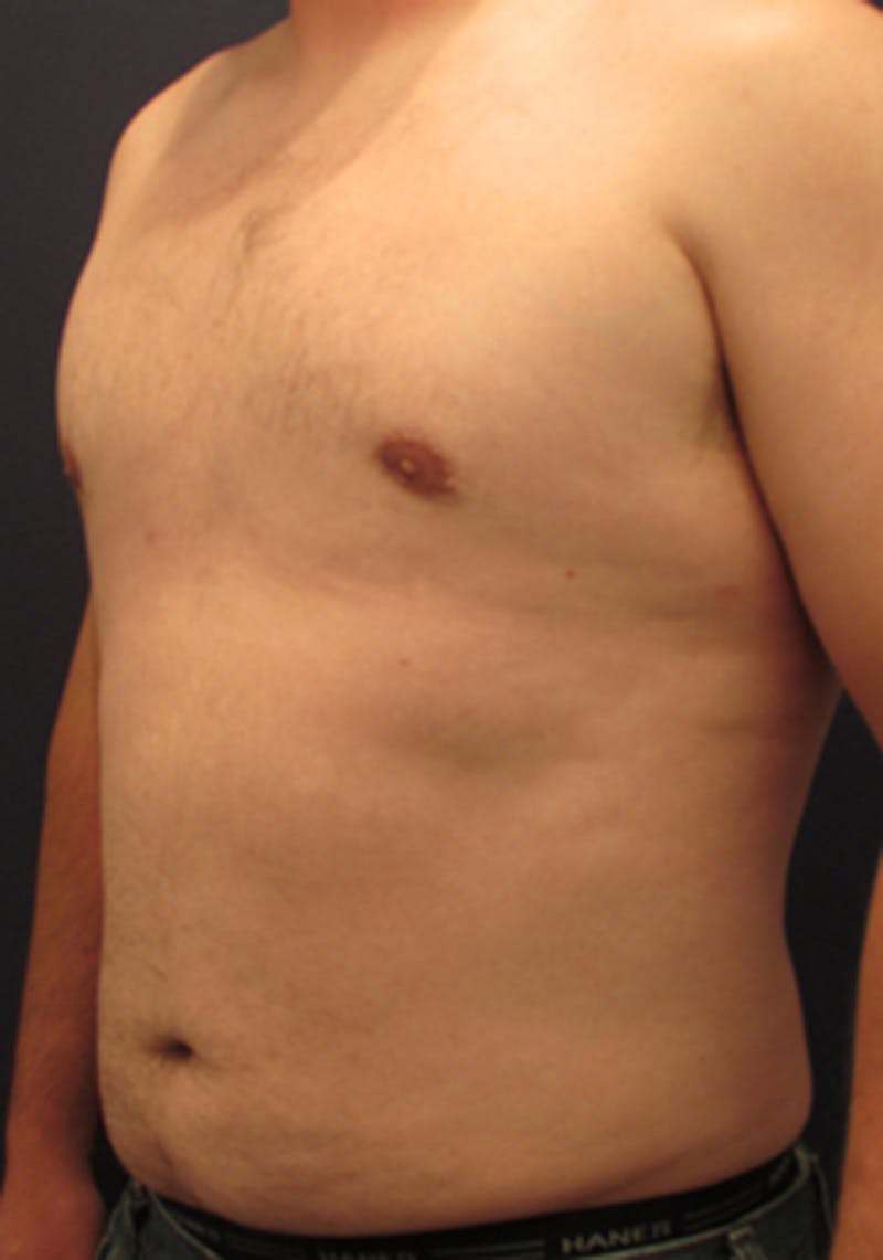 Liposuction Before & After Gallery - Patient 174163306 - Image 5