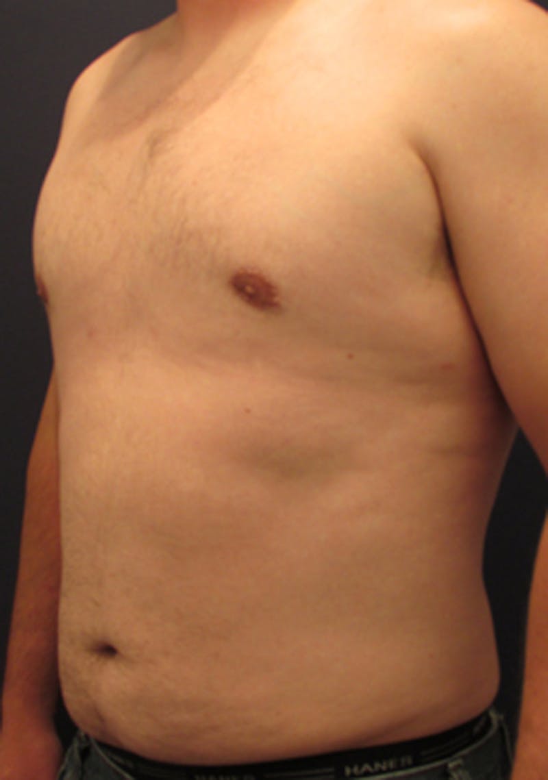 Liposuction Before & After Gallery - Patient 174163306 - Image 6