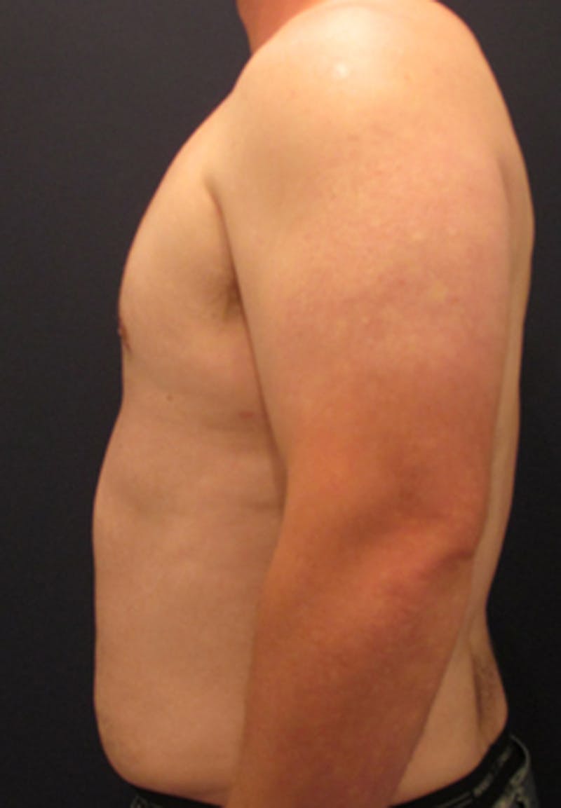 Liposuction Before & After Gallery - Patient 174163306 - Image 7